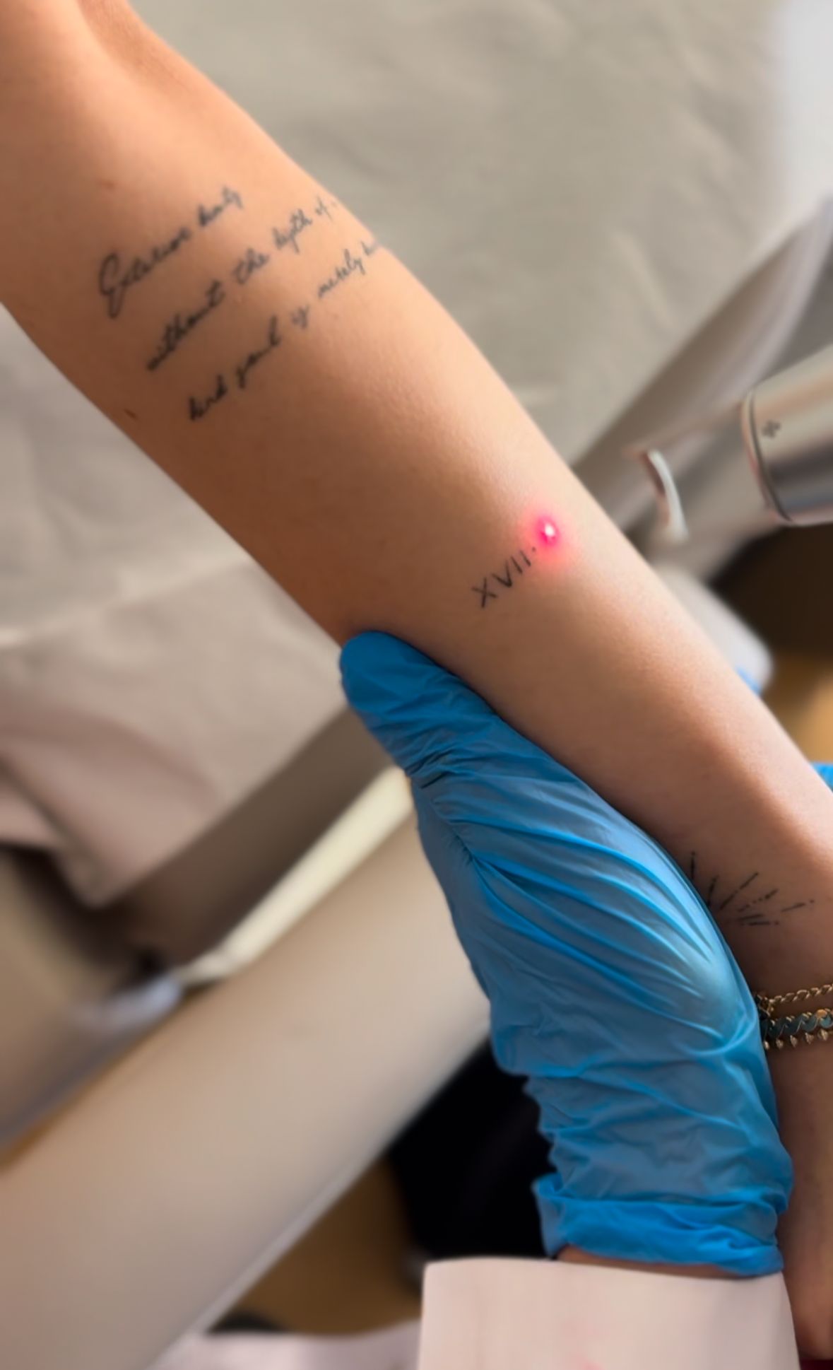 Dövme Silme - Q Switched Lazer