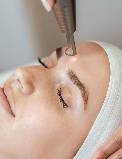 Leke Tedavisi - BBL Lazer Ve Q Switched Lazer